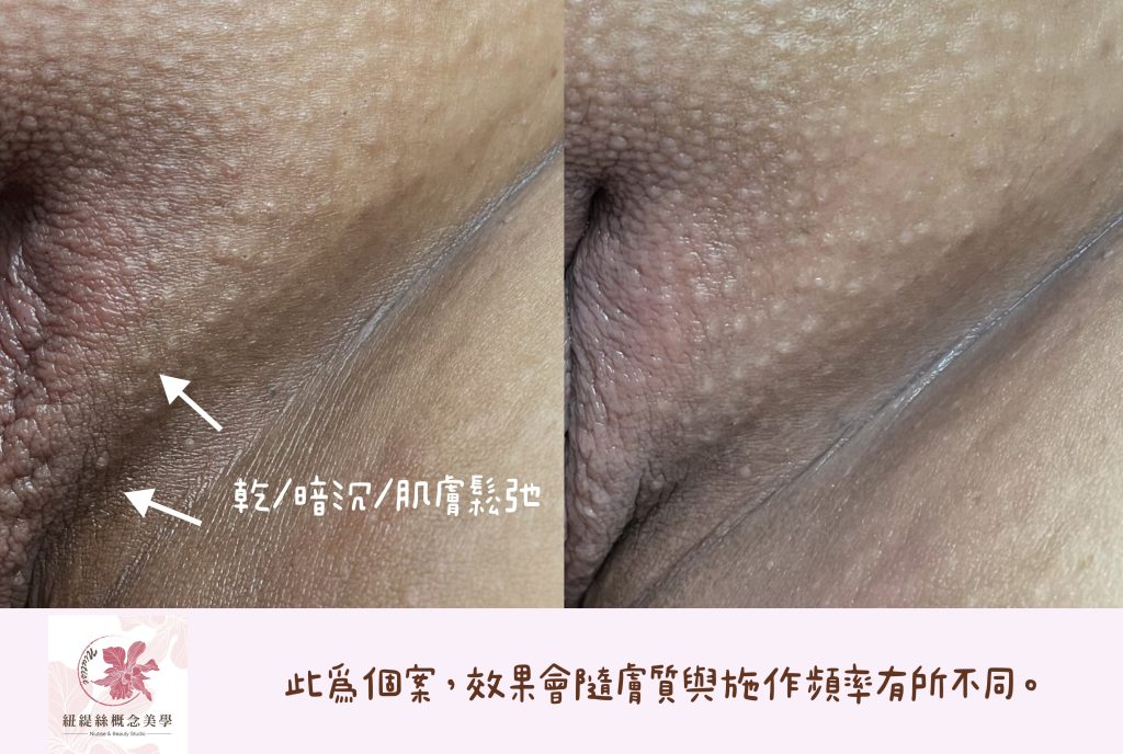 私密處熱蠟除毛案例2