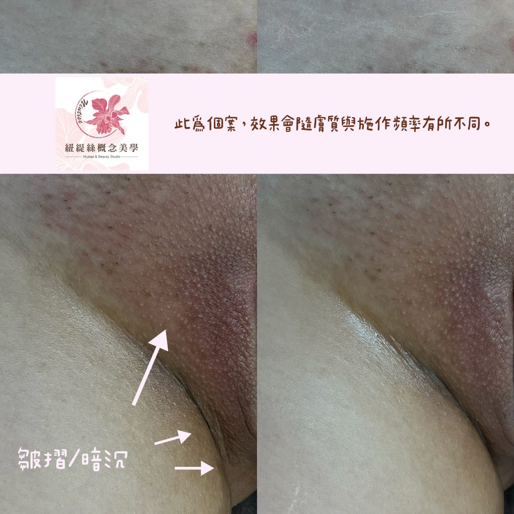 私密處熱蠟除毛案例1
